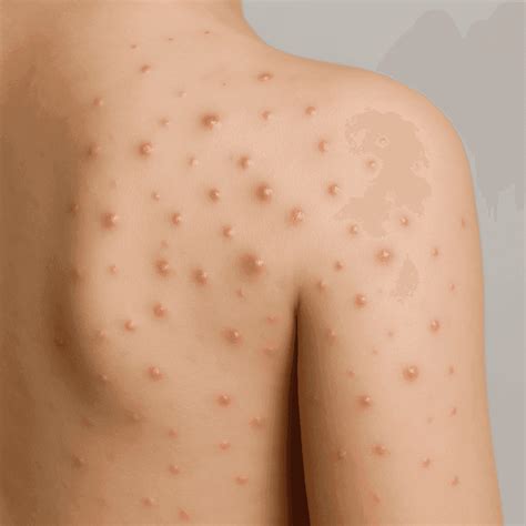 Pimples on a Child's Skin - When to See a Doctor