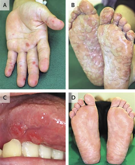 Where Is Hand Foot And Mouth Disease Most Common at James Kettler blog