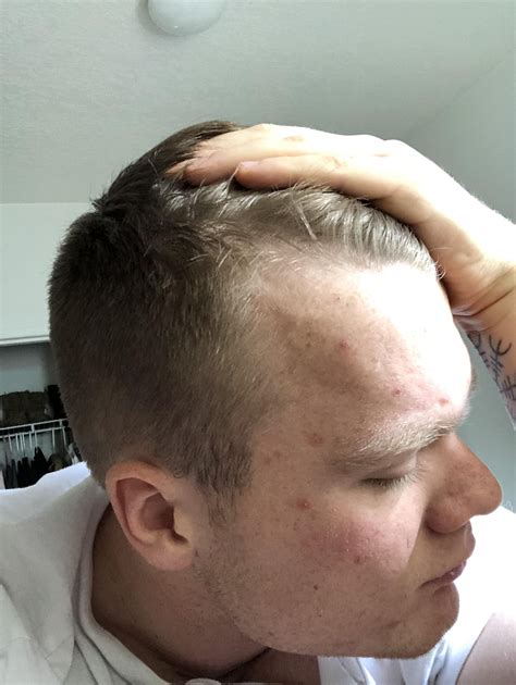 Does A Receding Hairline Mean That I Will Go Bald? - TBNSTF