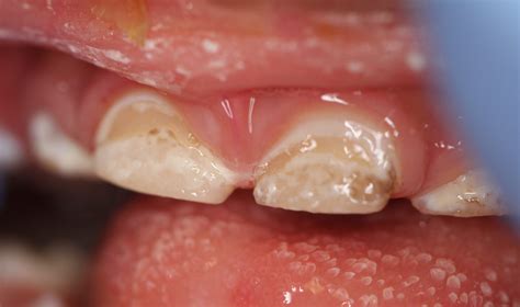 Staining or Cavities on the Front Teeth? | Playtime Dentistry