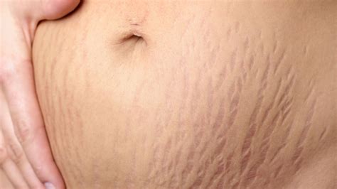 Tattoo Artist Hides Stretch Marks With Skin-Colored Ink - Before and ...
