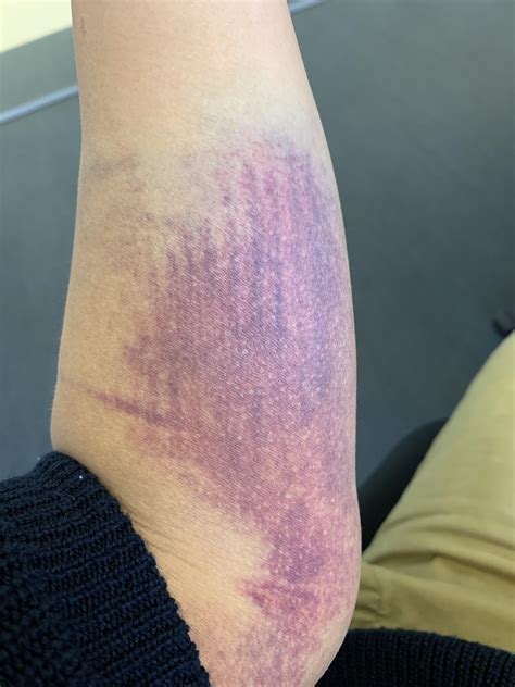 Elbow bruise takes fabric pattern : r/mildlyinteresting