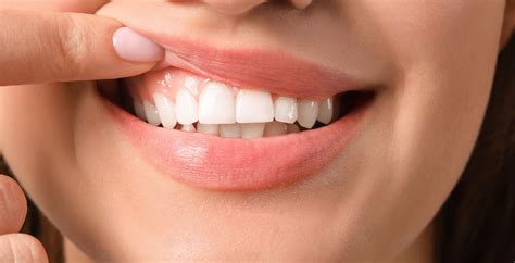 How To Stop Gum Recession: Causes & Treatments