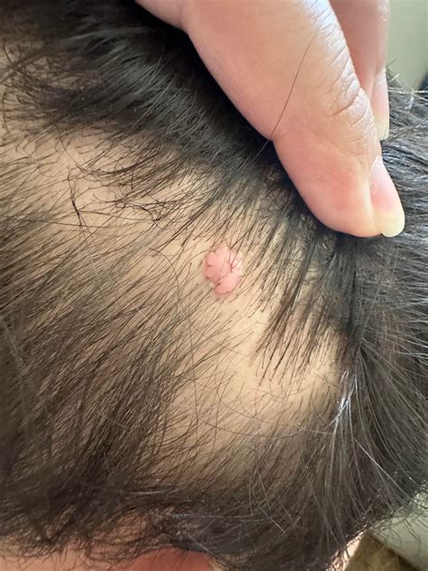 Been having a bump on scalp for 9 months. It does not hurt. What can i put on it ? : r ...