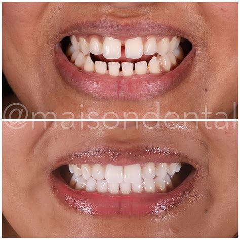 Invisalign Gap In Front Teeth