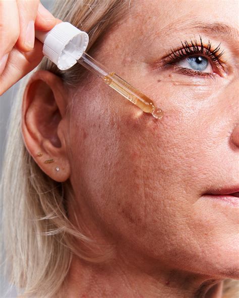 Does Retinol Help With Acne