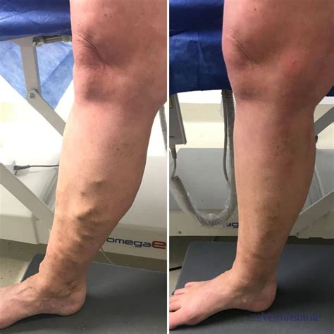Endovenous Laser Ablation (EVLA) Treatment | The Vein Institute