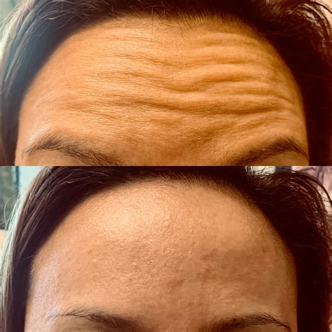 Botox crows feet treatment – Artofit