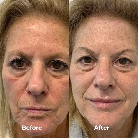 Radiofrequency Microneedling Before and After Photos - House of Beauty | Top Rated