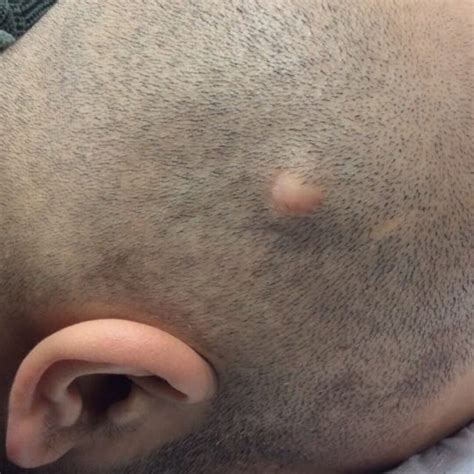 Pilar Cyst Removal: Causes, Treatment Options, and Recovery