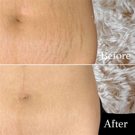 Best Scar Camouflage in NYC & Rahway, NJ | Arch Angels