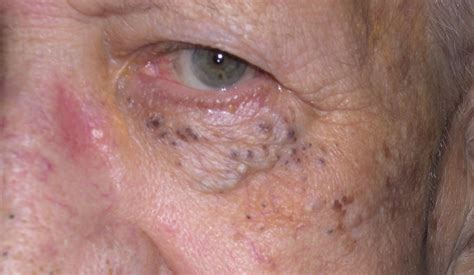 Comedone On Eyelid