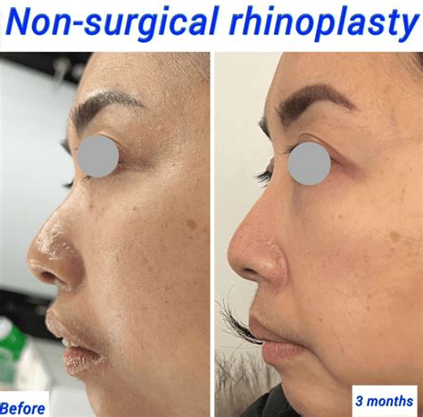 Non Surgical Rhinoplasty