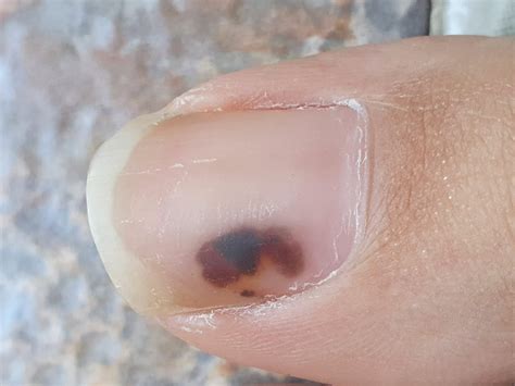 Black spot on toenail : r/Melanoma