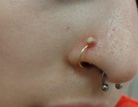 Piercing Nose Infection | Nose piercing bump, Piercing bump, Nose piercing