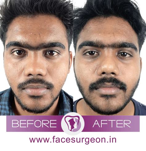 Surgery For Wide Face