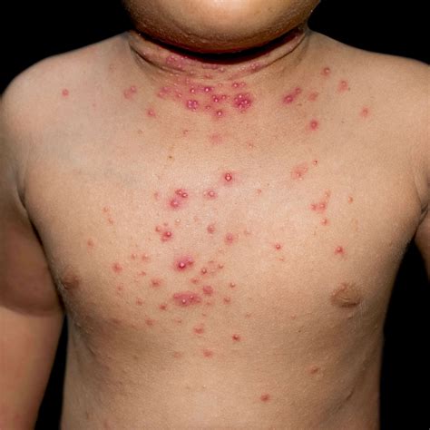 Molluscum contagiosum: Treat it naturally