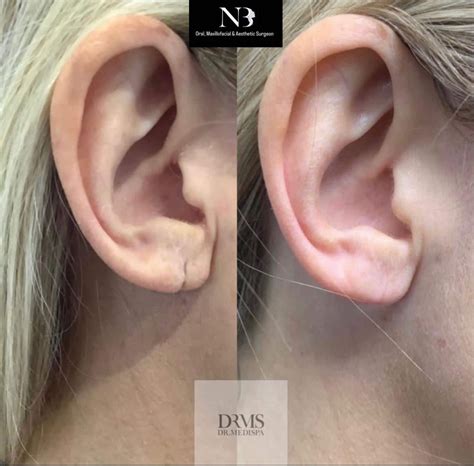 'Split' earlobe repair | The PMFA Journal