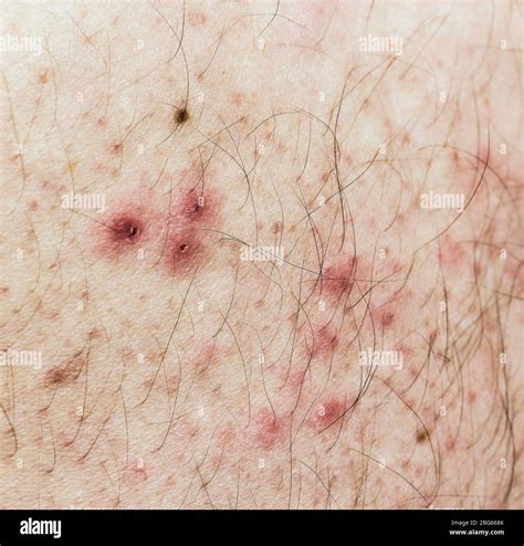 Herpes zoster rash blisters hi-res stock photography and images - Alamy