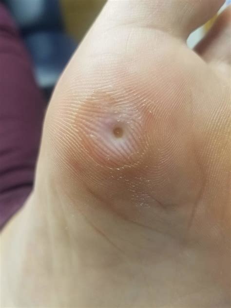 Why Does It Look Like I Have Holes In My Feet at Joseph Heil blog