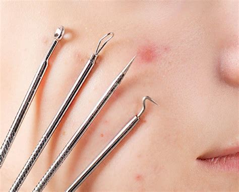 Blackheads 101: Learn how blackheads form, what causes them, and how to get rid of them – Baiden ...