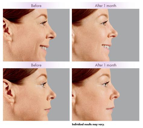 Juvederm Voluma Cheek Augmentation Dermal Filler Cheeks Lift, Volume in San Francisco, CA
