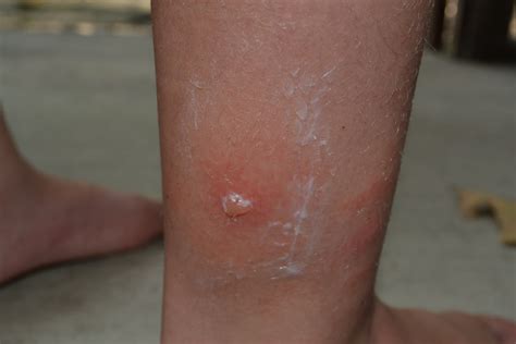 Natural Treatments For Scorpion Stings