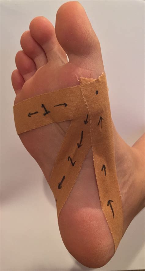How To Tape Your Foot For Plantar Fasciitis - Plant Ideas