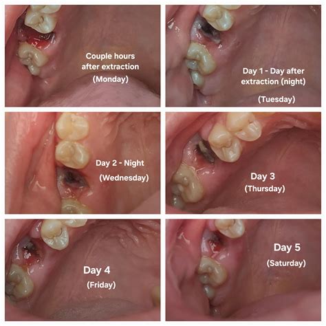 Normal Tooth Extraction Healing Process