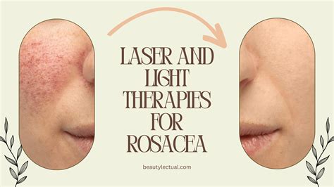 Rosacea Treatments Laser And Light Therapies: Experience Intense Dye Therapy for Rosacea Treatment