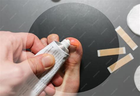 Premium Photo | Callus blisters on feet Man is applying cream on ...