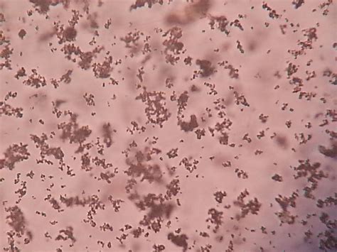 Amorphous Urate Crystals in Urine Sediment