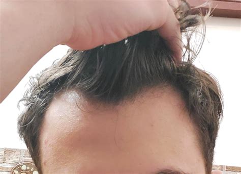 Receding Hairline At 20: Signs, Symptoms & Treatments