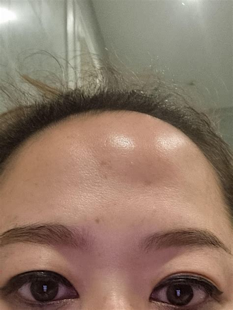 what is this weird sudden bump on my forehead??? : r/medical