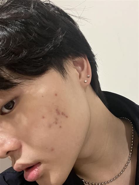 Hyperpigmentation help : r/SkincareAddicts