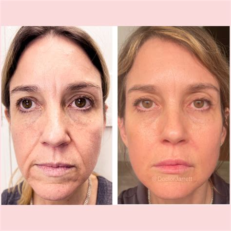 Smile Lines & Nasolabial Fold Fillers - Designer Aesthetics by Dr. Jarrett Schanzer | Miami