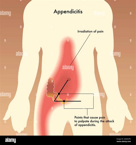 Appendicitis Pain Location Diagram