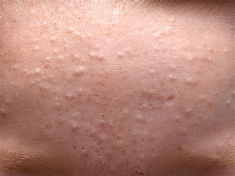 Bumps On Face Not Pimples