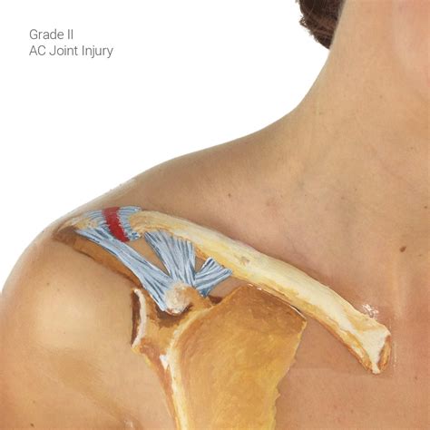 AC Joint Seperations and Injuries a Patients Guide