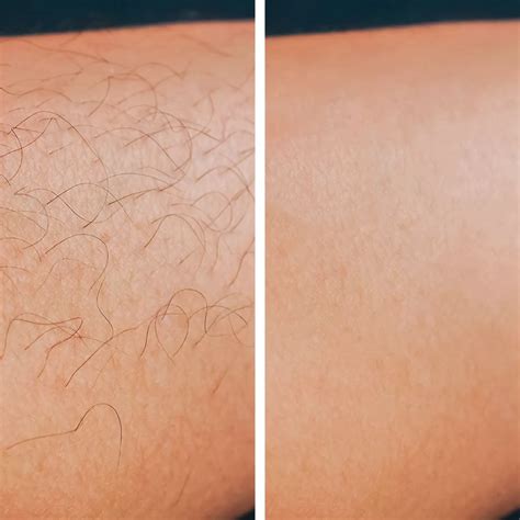 Laser Hair Removal Legs Before And After