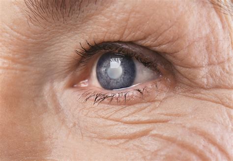6 Early Signs of Glaucoma: What You Need To Know