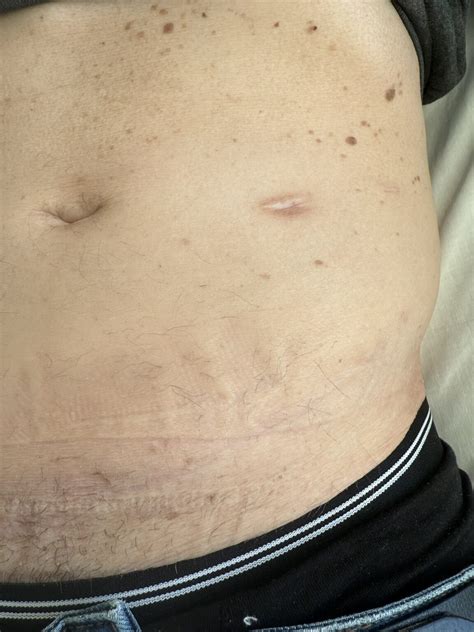 Neurofibromatosis - PACES AID