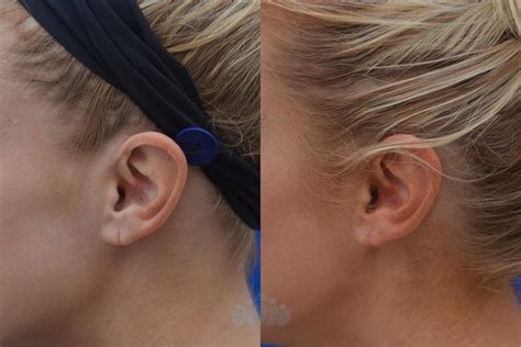 Earlobe Repair Before and After Pictures Case 53 | Charlotte, NC | Dilworth Facial Plastic Surgery