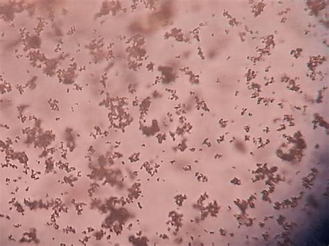 Amorphous Crystals In Human Urine at Carole Spears blog