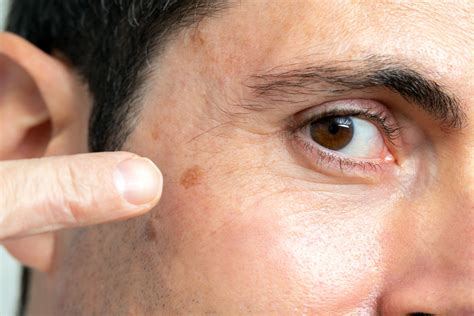 Basal Cell Carcinoma Early Stages Face