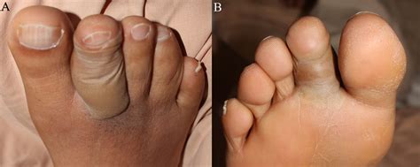 Blistering Distal Dactylitis - The American Journal of Medicine