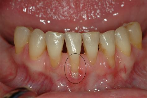 Gingivitis Gum Recession at Stephanie Lankford blog