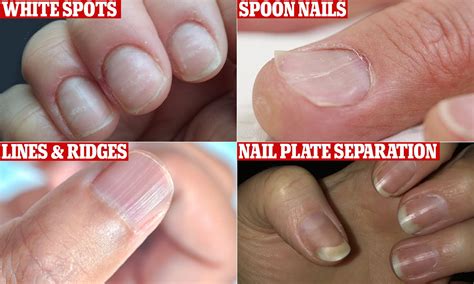 Raised Bumps On Fingernails