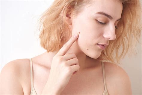 Why Do You Get Skin Moles and Beauty Marks? - Metrin Skincare