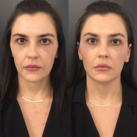 Dermal Filler Brisbane | Cosmetic and Face Filler Packages